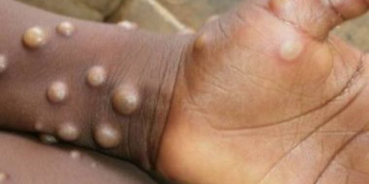 SeSaB faz recomendações para evitar contágio da varíola dos macacos: ‘Não há casos suspeitos’