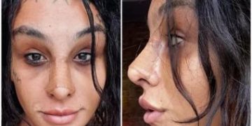 Feminização facial: como é a cirurgia para pessoas trans