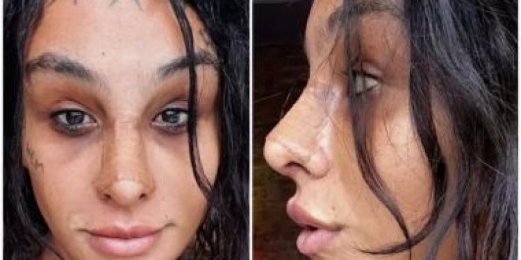 Feminização facial: como é a cirurgia para pessoas trans