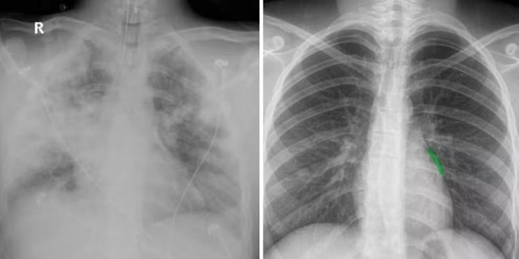 Mãe alerta sobre como vape contribuiu para morte de filho aos 20 anos após infecção: ‘pulmão não reagiu’